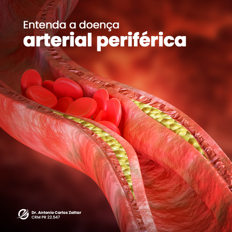 Entenda a doença arterial periférica 